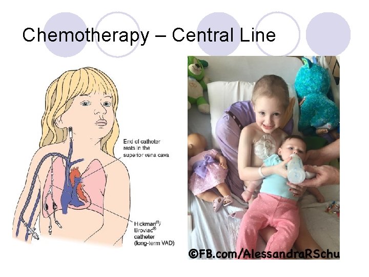Chemotherapy – Central Line 