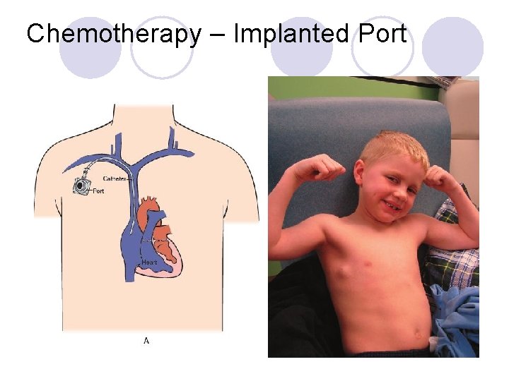 Chemotherapy – Implanted Port 