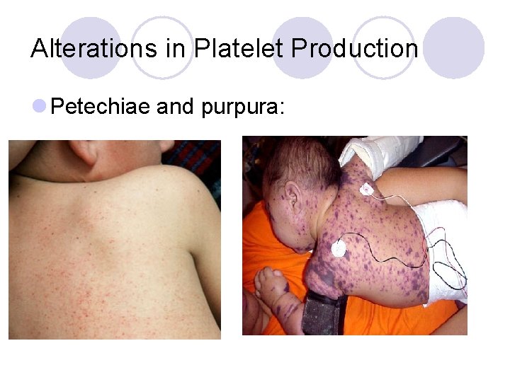 Alterations in Platelet Production l Petechiae and purpura: 