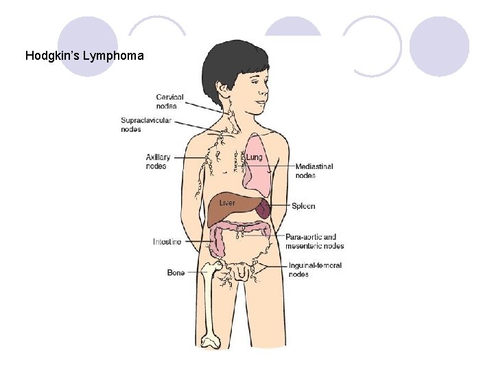 Hodgkin’s Lymphoma 