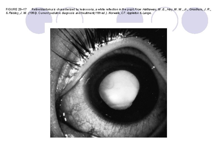 FIGURE 29– 17 Retinoblastoma is characterized by leukocoria, a white reflection in the pupil.
