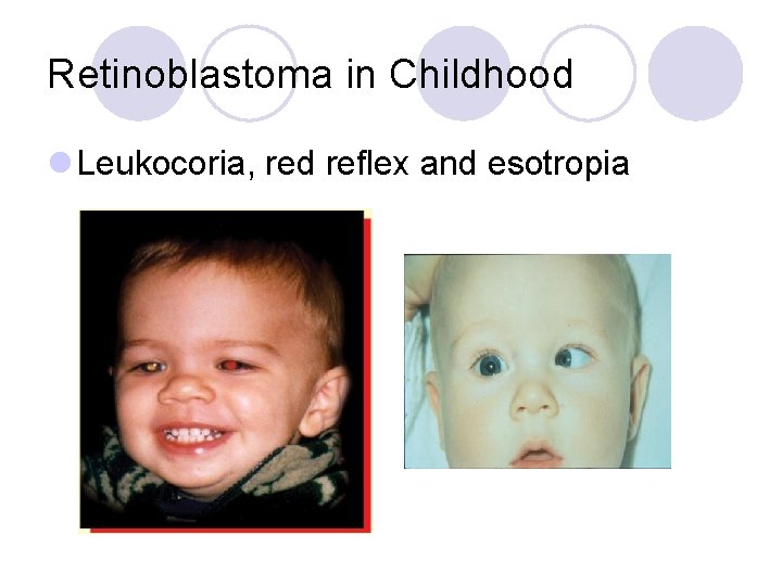 Retinoblastoma in Childhood l Leukocoria, red reflex and esotropia 
