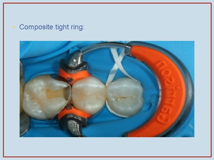  • Composite tight ring: 