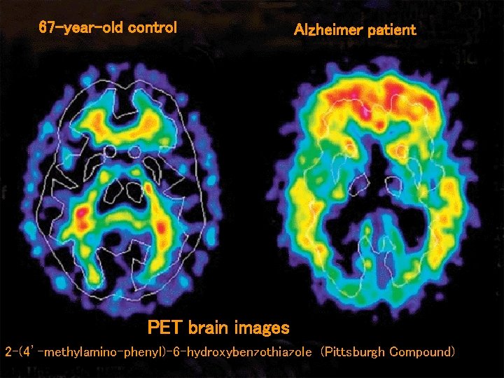 67 -year-old control Alzheimer patient PET brain images 2 -(4’-methylamino-phenyl)-6 -hydroxybenzothiazole (Pittsburgh Compound) 