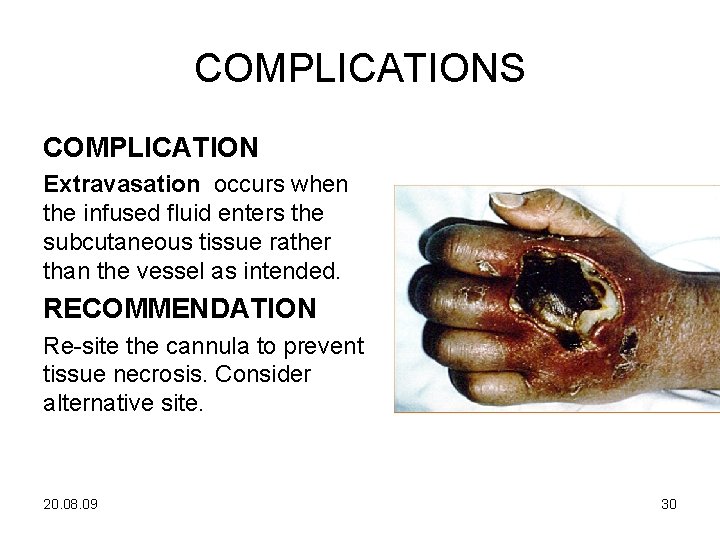 COMPLICATIONS COMPLICATION Extravasation occurs when the infused fluid enters the subcutaneous tissue rather than