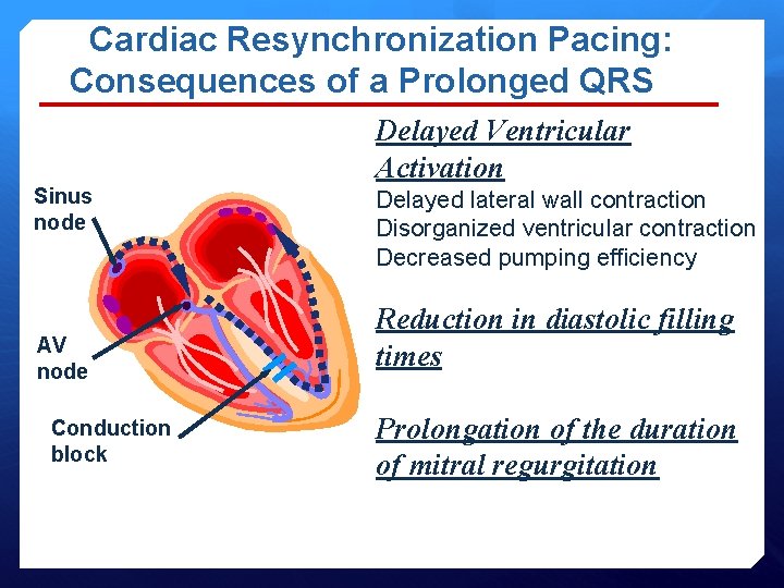  Cardiac Resynchronization Pacing: Consequences of a Prolonged QRS Delayed Ventricular Activation Sinus node
