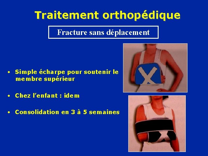 Traitement orthopédique Fracture sans déplacement • Simple écharpe pour soutenir le membre supérieur •