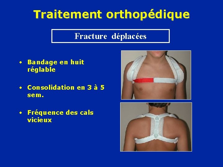Traitement orthopédique Fracture déplacées • Bandage en huit réglable • Consolidation en 3 à