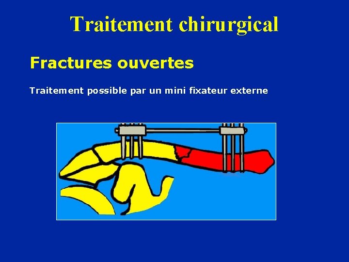 Traitement chirurgical Fractures ouvertes Traitement possible par un mini fixateur externe 