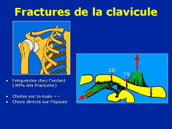 Fractures de la clavicule • Fréquentes chez l’enfant (30% des fractures) • • Chutes