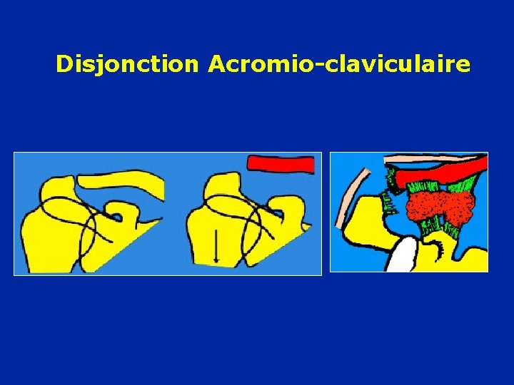 Disjonction Acromio-claviculaire 