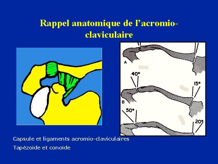 Rappel anatomique de l’acromioclaviculaire Capsule et ligaments acromio-claviculaires Tapèzoïde et conoïde 