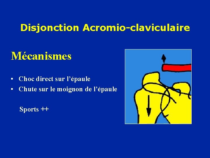 Disjonction Acromio-claviculaire Mécanismes • Choc direct sur l’épaule • Chute sur le moignon de