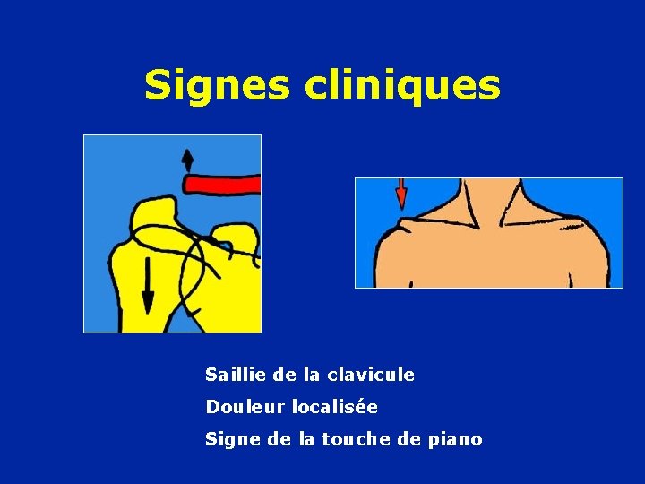 Signes cliniques Saillie de la clavicule Douleur localisée Signe de la touche de piano