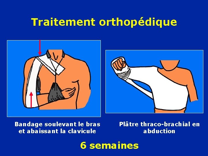 Traitement orthopédique Bandage soulevant le bras et abaissant la clavicule Plâtre thraco-brachial en abduction