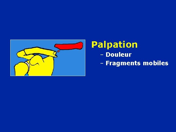 Palpation – Douleur – Fragments mobiles 