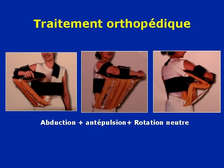 Traitement orthopédique Abduction + antépulsion+ Rotation neutre 