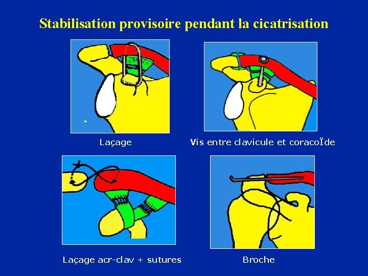 Stabilisation provisoire pendant la cicatrisation Laçage acr-clav + sutures Vis entre clavicule et coracoÏde