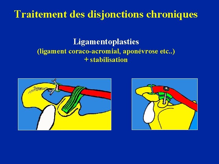 Traitement des disjonctions chroniques Ligamentoplasties (ligament coraco-acromial, aponévrose etc. . ) + stabilisation 