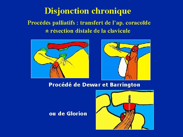 Disjonction chronique Procédés palliatifs : transfert de l’ap. coracoïde ± résection distale de la
