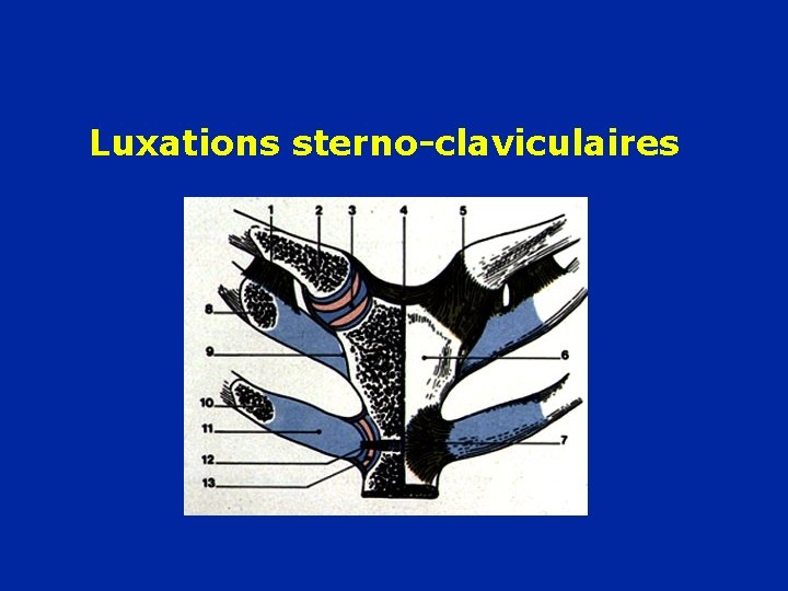Luxations sterno-claviculaires 