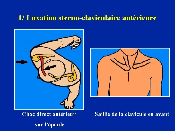 1/ Luxation sterno-claviculaire antérieure Choc direct antérieur sur l’épaule Saillie de la clavicule en