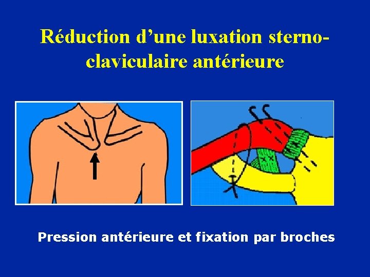 Réduction d’une luxation sternoclaviculaire antérieure Pression antérieure et fixation par broches 