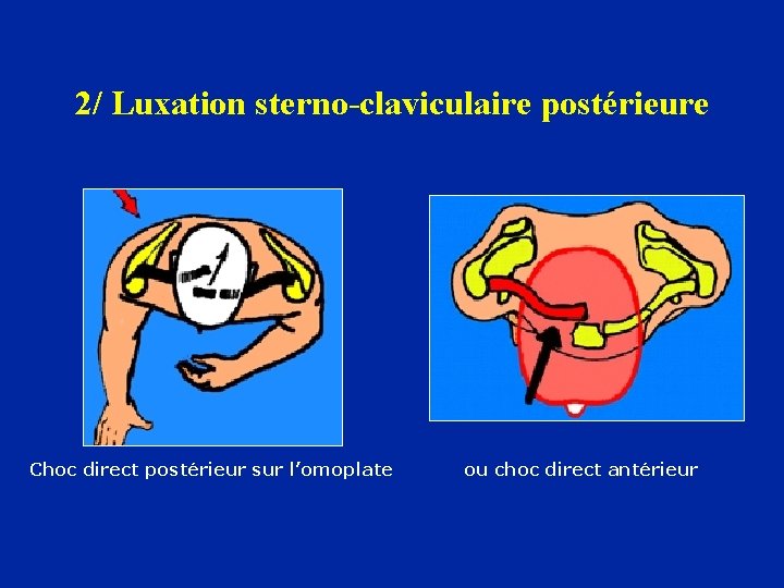 2/ Luxation sterno-claviculaire postérieure Choc direct postérieur sur l’omoplate ou choc direct antérieur 