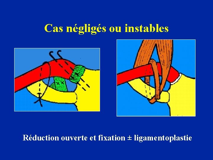 Cas négligés ou instables Réduction ouverte et fixation ± ligamentoplastie 