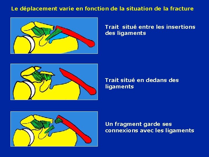 Le déplacement varie en fonction de la situation de la fracture Trait situé entre