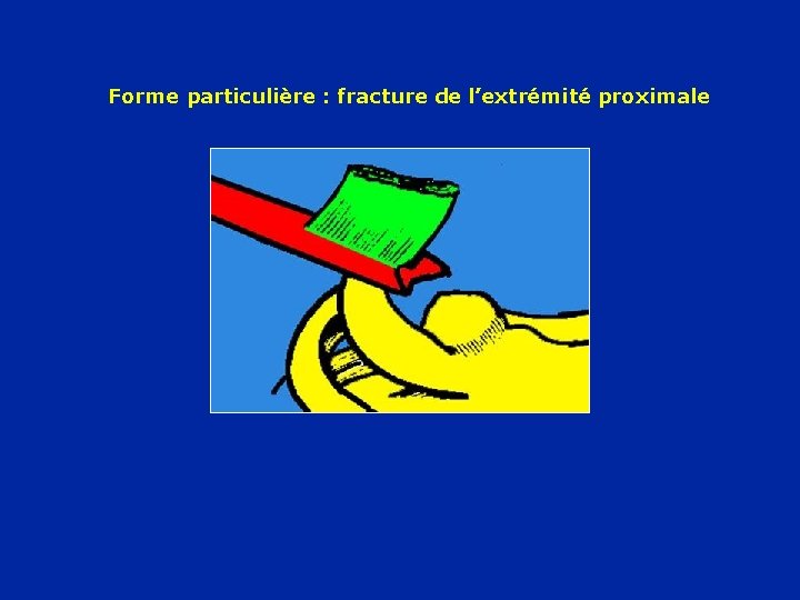 Forme particulière : fracture de l’extrémité proximale 