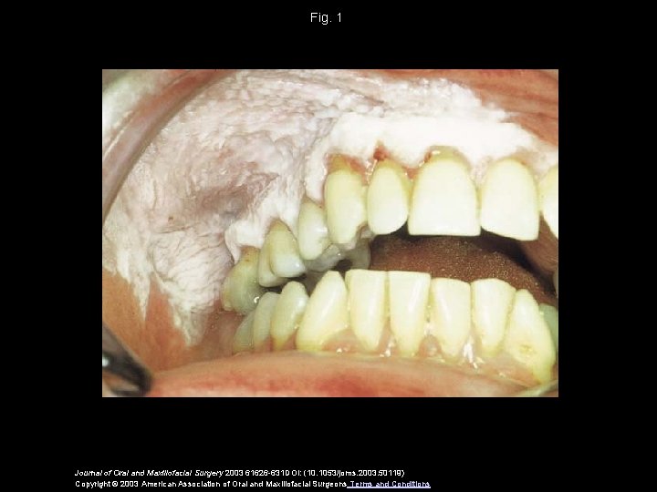 Fig. 1 Journal of Oral and Maxillofacial Surgery 2003 61626 -631 DOI: (10. 1053/joms.