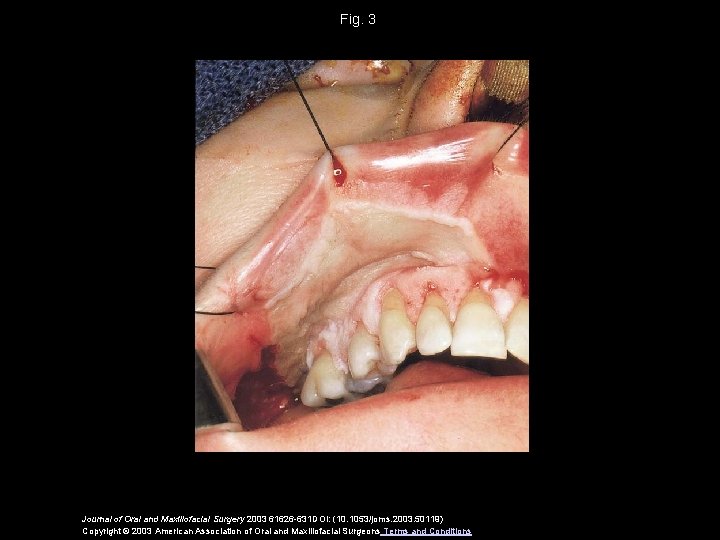 Fig. 3 Journal of Oral and Maxillofacial Surgery 2003 61626 -631 DOI: (10. 1053/joms.