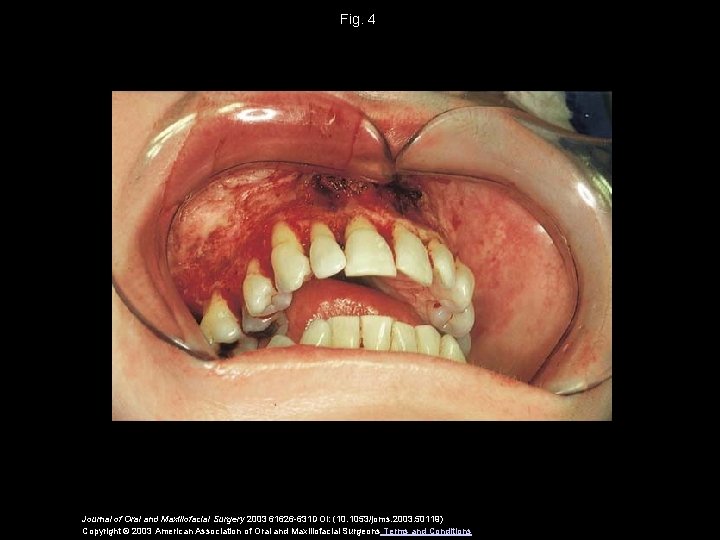 Fig. 4 Journal of Oral and Maxillofacial Surgery 2003 61626 -631 DOI: (10. 1053/joms.