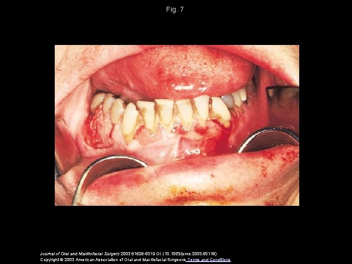 Fig. 7 Journal of Oral and Maxillofacial Surgery 2003 61626 -631 DOI: (10. 1053/joms.