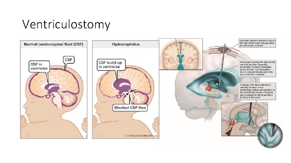 Ventriculostomy 