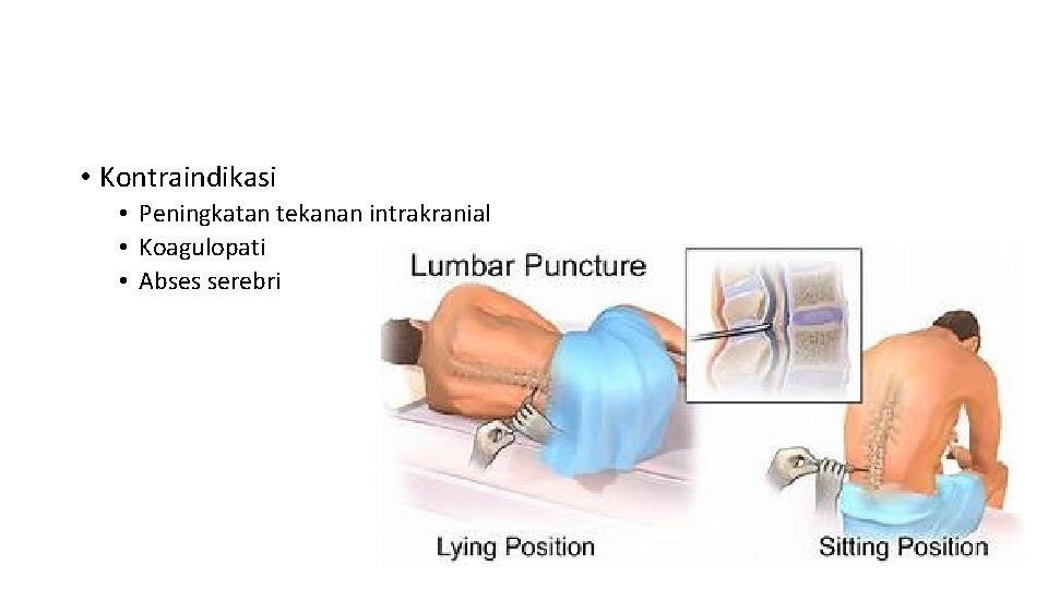  • Kontraindikasi • Peningkatan tekanan intrakranial • Koagulopati • Abses serebri 