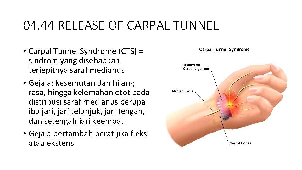 04. 44 RELEASE OF CARPAL TUNNEL • Carpal Tunnel Syndrome (CTS) = sindrom yang