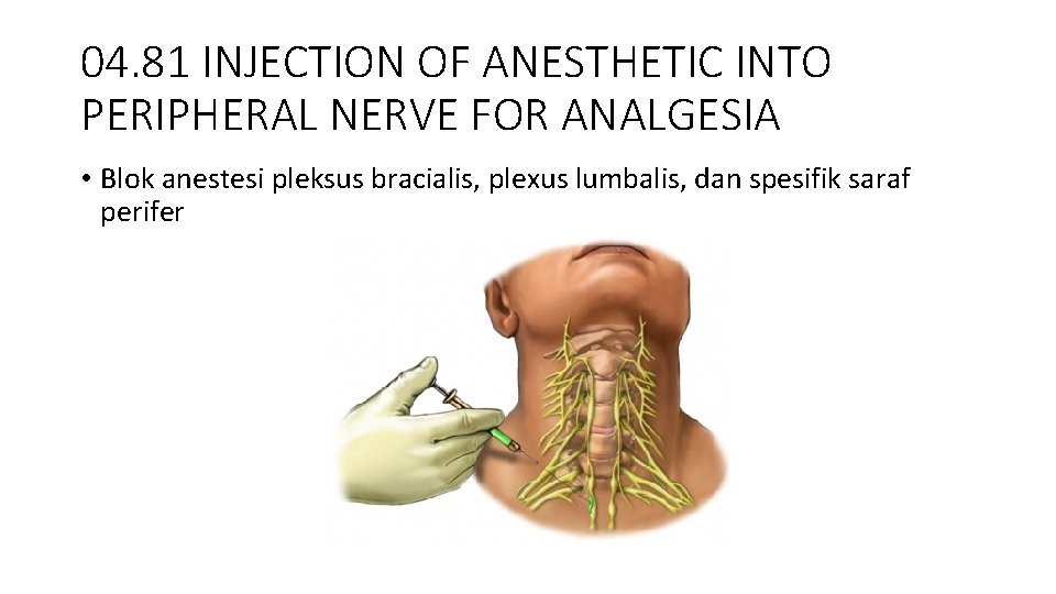 04. 81 INJECTION OF ANESTHETIC INTO PERIPHERAL NERVE FOR ANALGESIA • Blok anestesi pleksus