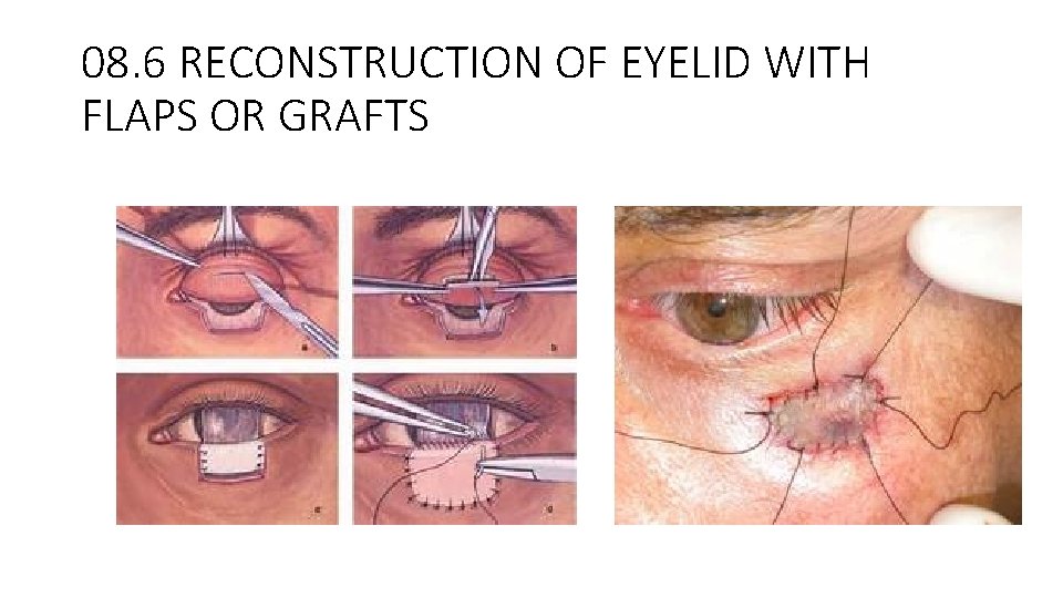 08. 6 RECONSTRUCTION OF EYELID WITH FLAPS OR GRAFTS 