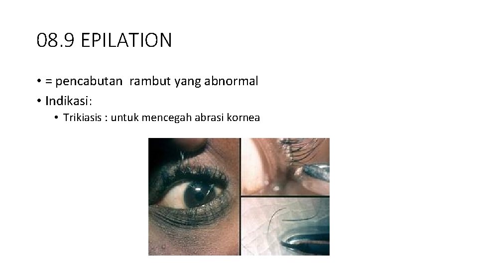 08. 9 EPILATION • = pencabutan rambut yang abnormal • Indikasi: • Trikiasis :