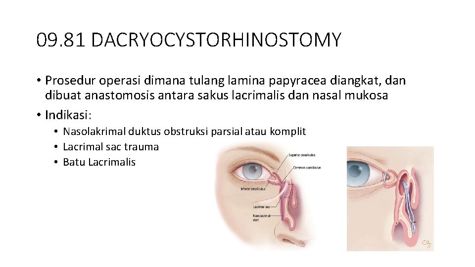 09. 81 DACRYOCYSTORHINOSTOMY • Prosedur operasi dimana tulang lamina papyracea diangkat, dan dibuat anastomosis