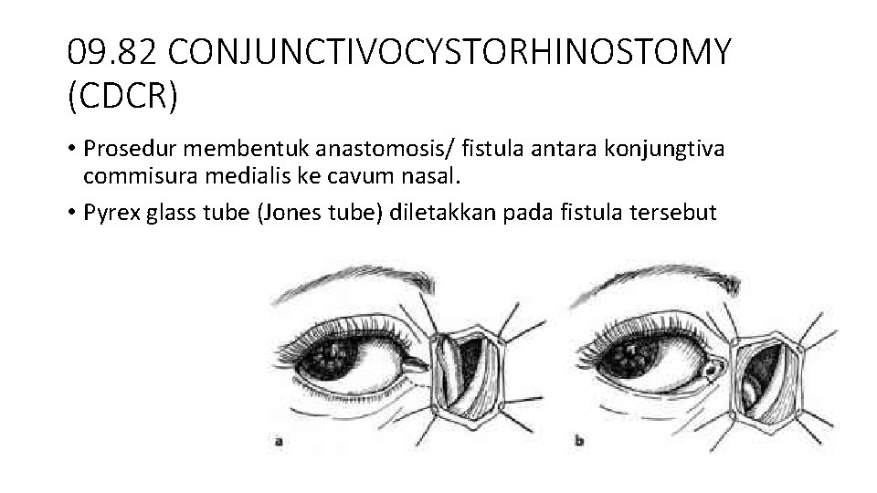 09. 82 CONJUNCTIVOCYSTORHINOSTOMY (CDCR) • Prosedur membentuk anastomosis/ fistula antara konjungtiva commisura medialis ke