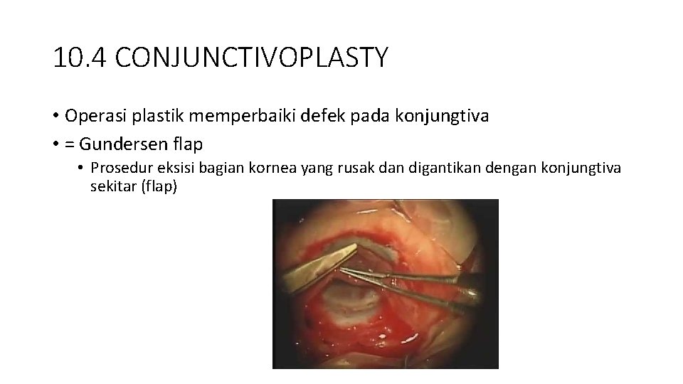 10. 4 CONJUNCTIVOPLASTY • Operasi plastik memperbaiki defek pada konjungtiva • = Gundersen flap