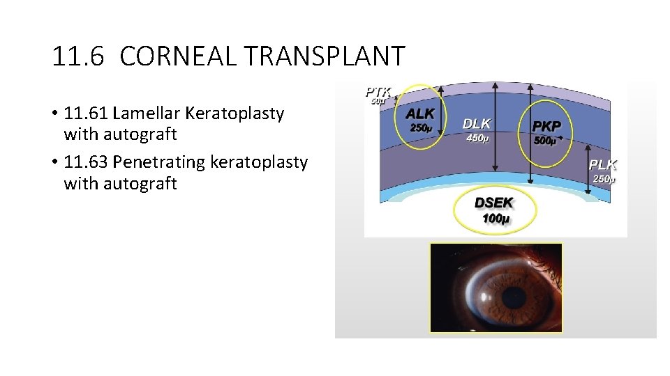 11. 6 CORNEAL TRANSPLANT • 11. 61 Lamellar Keratoplasty with autograft • 11. 63