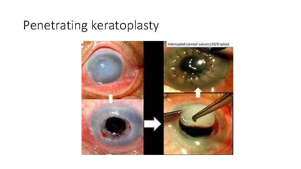 Penetrating keratoplasty 