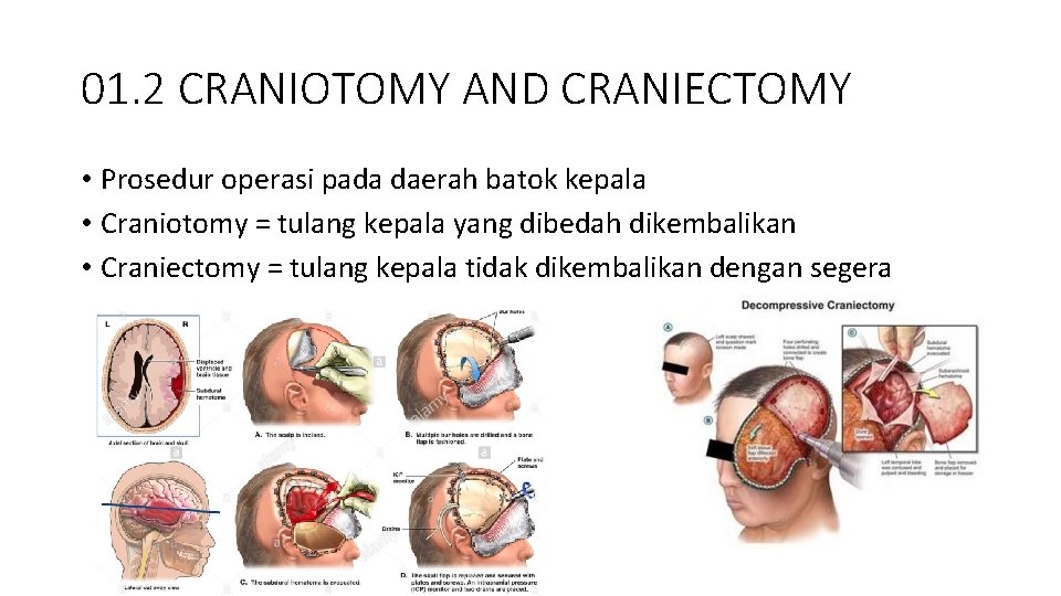 01. 2 CRANIOTOMY AND CRANIECTOMY • Prosedur operasi pada daerah batok kepala • Craniotomy