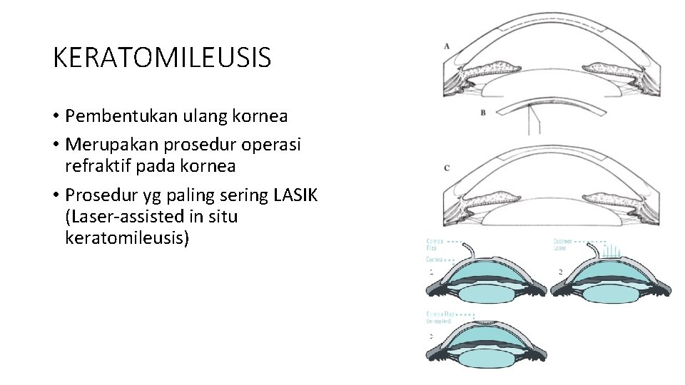 KERATOMILEUSIS • Pembentukan ulang kornea • Merupakan prosedur operasi refraktif pada kornea • Prosedur