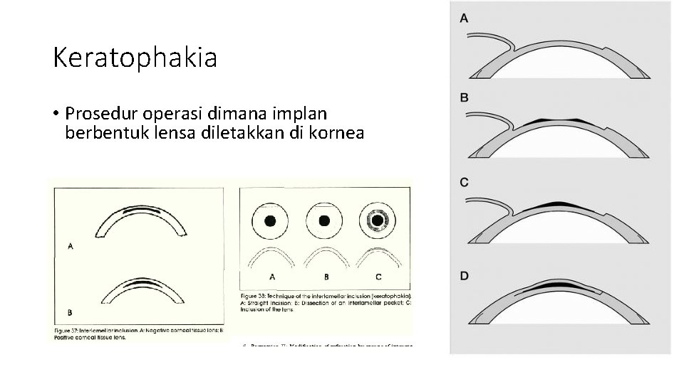 Keratophakia • Prosedur operasi dimana implan berbentuk lensa diletakkan di kornea 