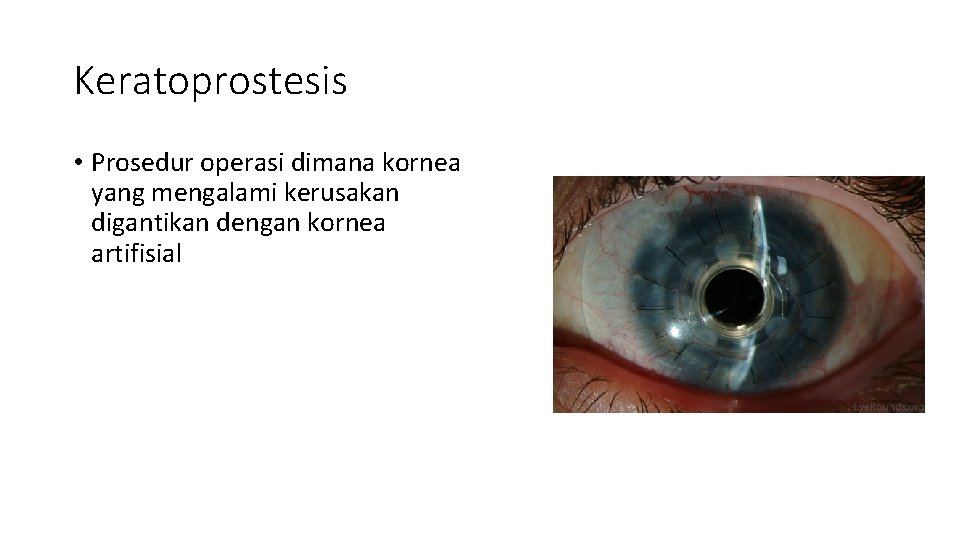 Keratoprostesis • Prosedur operasi dimana kornea yang mengalami kerusakan digantikan dengan kornea artifisial 